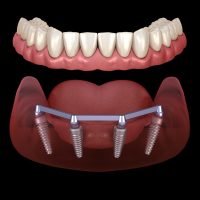 Overdenture in Chicopee