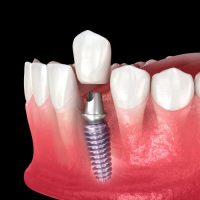 Single Implant in Chicopee