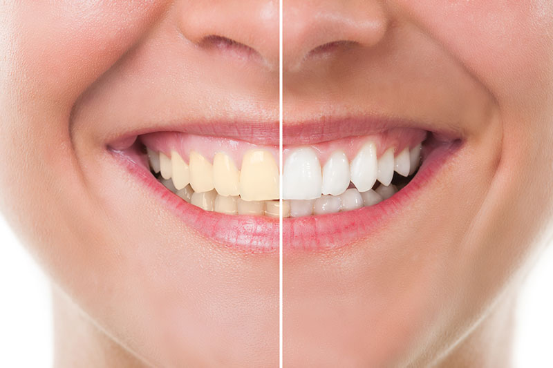 Teeth Whitening in Chicopee