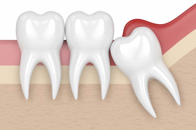 Wisdom Tooth Removal in Chicopee