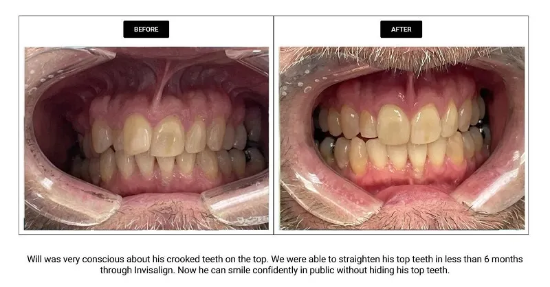 Before and After dental appointment
